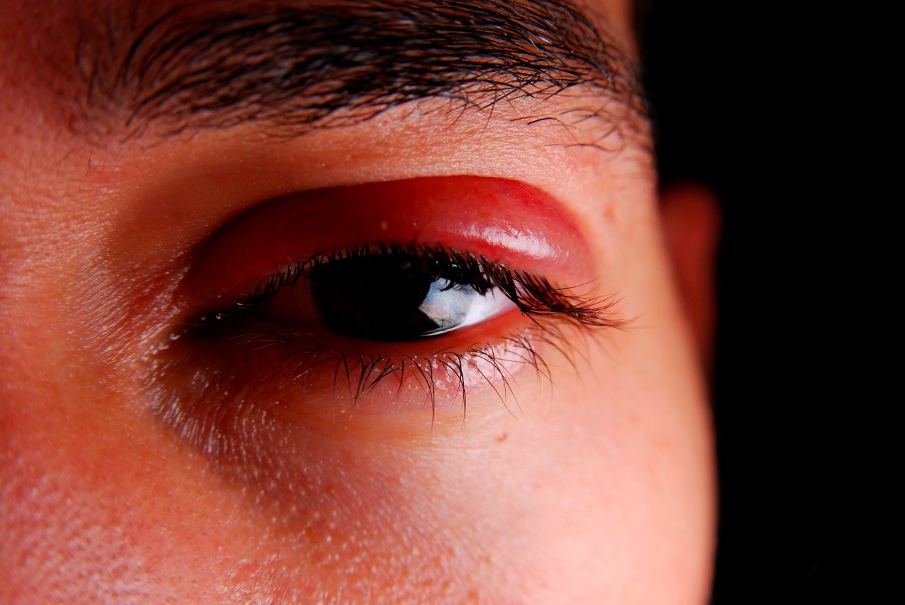 Swollen Eyes And Eyelids: Why And How To Treat Them