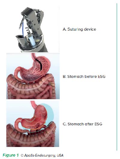 ESG Suturing Device