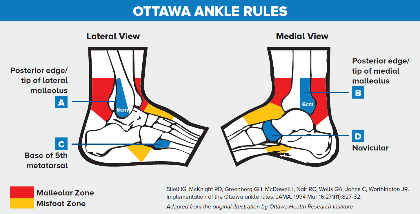 Ottawa Ankle Rules