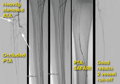 BTK-anterior tibial angioplasty (ATA), posterior tibial artery (PTA) SAFARI - SingHealth Duke-NUS Vascular Centre