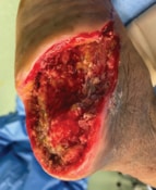 Clean wound after surgical debridements  - SingHealth Duke-NUS Vascular Centre