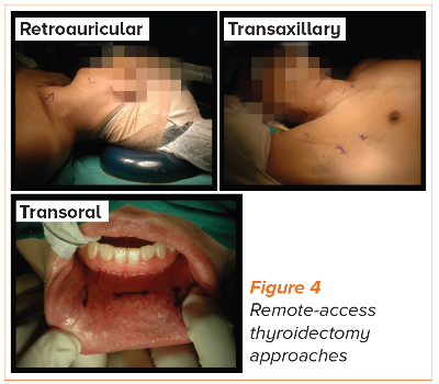 Remote-access thyroidectomy approaches SingHealth Duke-NUS Head & Neck Centre