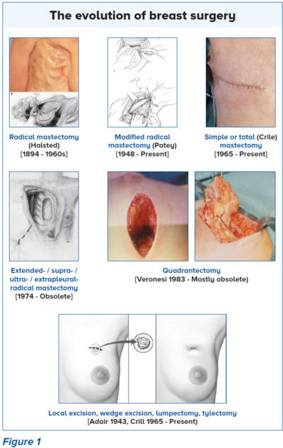 Evolution of Breast Surgery - SingHealth Duke-NUS Breast Centre