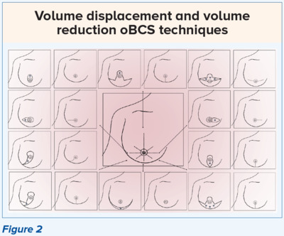 Volume Displacement and Volume Reduction oBCS Techniques - SingHealth Duke-NUS Breast Centre