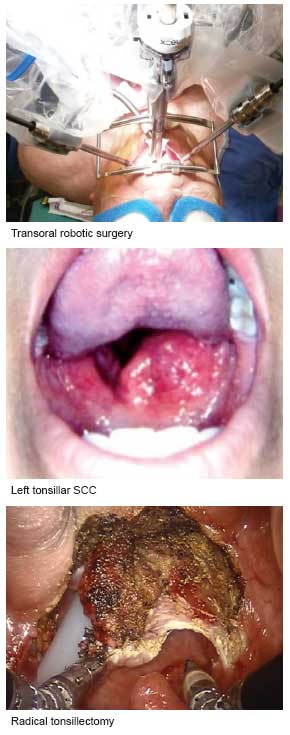 Head and neck cancer and multidisciplinary care at National Cancer Centre Singapore.