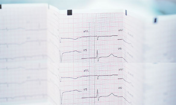  Transcatheter Aortic Valve Implantation (TAVI) ​has emerged as an alternative treatment of severe symptomatic AS in patients who are not suitable for conventional surgical aortic valve replacement due to high surgical risks.