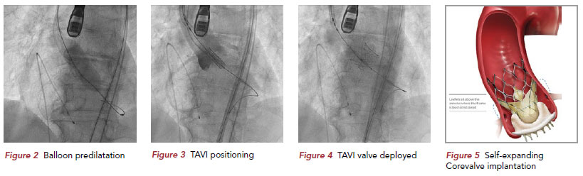 TAVI scans and illustration