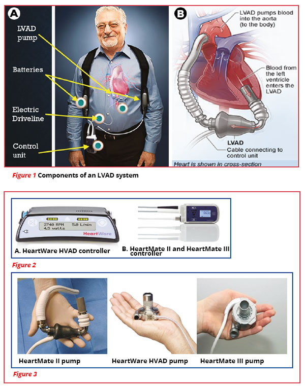 Left Ventricular Assist Device (LVAD)