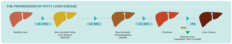progression of fatty liver disease