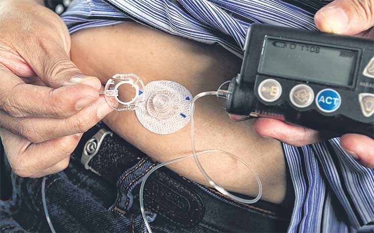  ​contains a syringe-likeinsulin reservoir with about three days’ supply.