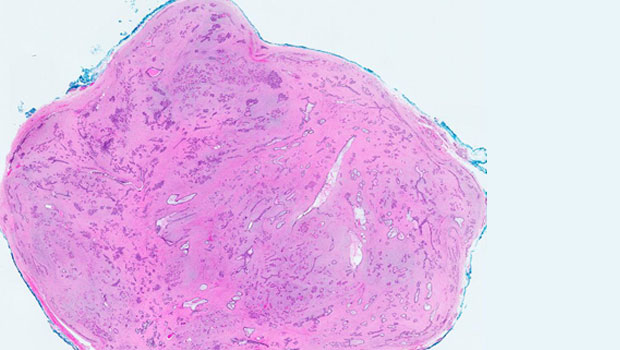  ​Photo Stained histopathology slide of a fibroadenoma viewed under low-power magnification.