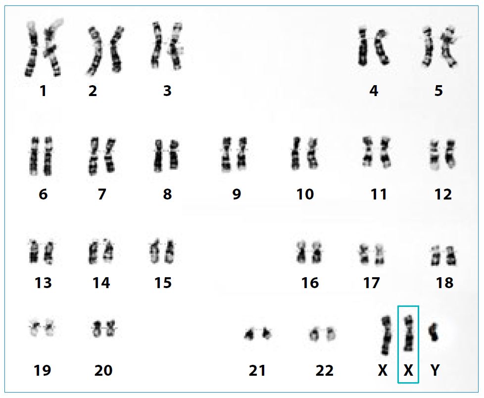 Karyotype showing Klinefelter Syndrome