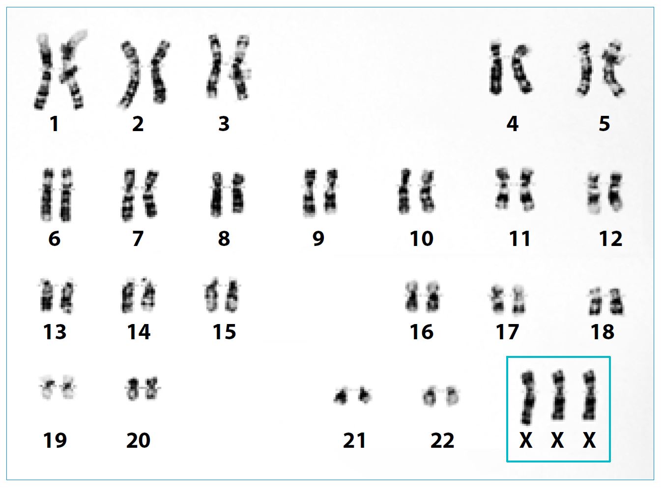 Karyotype showing triple X syndrome