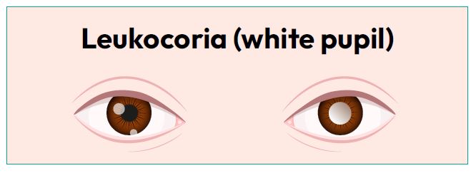 Leukocoria (white pupil)