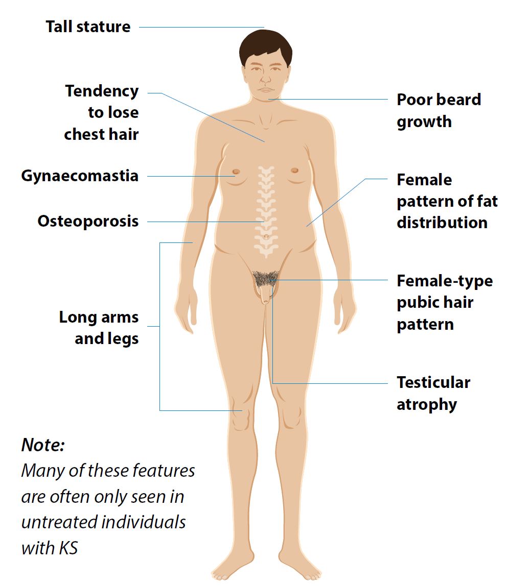 The typical features of Klinefelter Syndrome in an adult (if untreated)