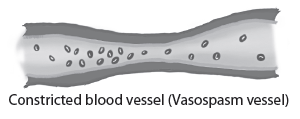 Brain aneurysm constricted blood vessel