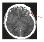 Contusion or bruising in the brain