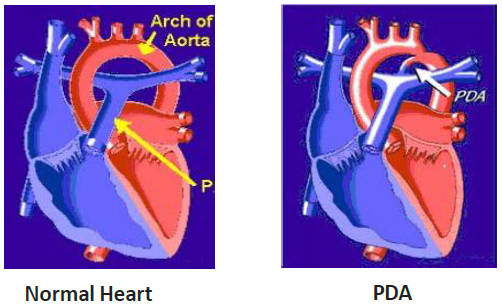 Patent Ductus Arteriosus