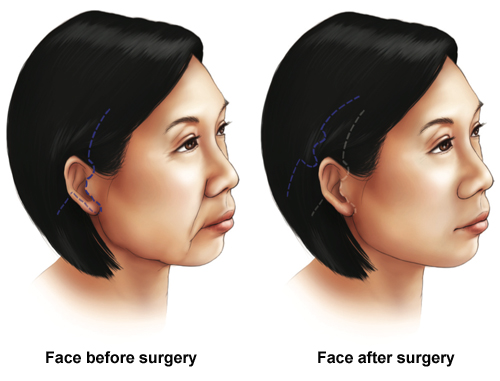 Face-Lift (rhytidectomy)  - face before and after surgery - conditions and treatments