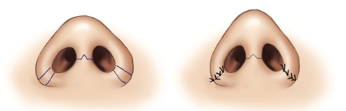 Rhinoplasty procedure