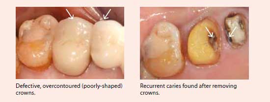 Defective fillings or restorations - National Dental Centre Singapore