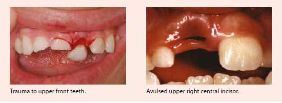 Traumatic injuries to the face and mouth from sports or other accidents - National Dental Centre Singapore