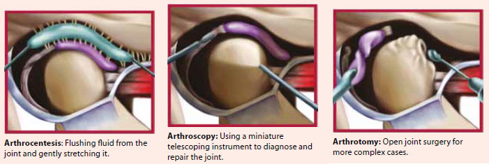 Surgery treatment for temporomandibular joint disorders - National Dental Centre Singapore