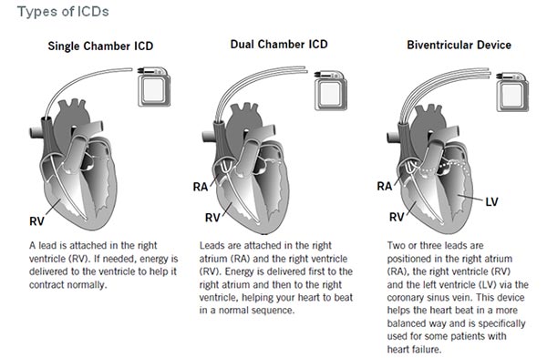 types of icds