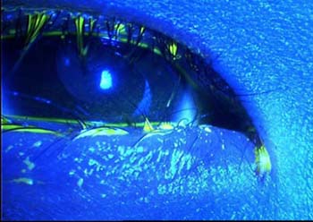 epiblepharon causes eyelashes rubbing against cornea