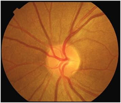 normal optic nerve head