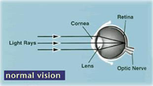 Myopic Maculopathy Normal Vision