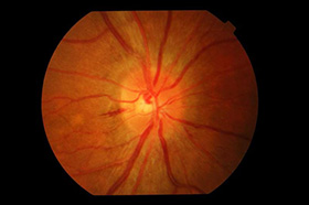 optic neuritis - resolution of right optic disc swelling in the same patient two weeks later