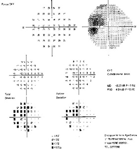 optic neuritis swollen left visual field