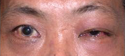 Patient with left orbital inflammation presenting with left eye swelling and redness (non-specific inflammatory disorder of the lacrimal gland)