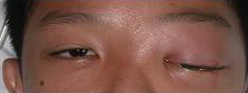 Child with left orbital cellulitis presenting with fever and left eye swelling and redness
