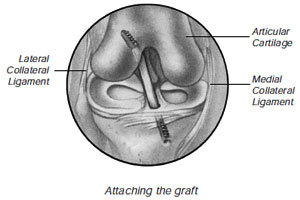 Anterior cruciate ligament surgery