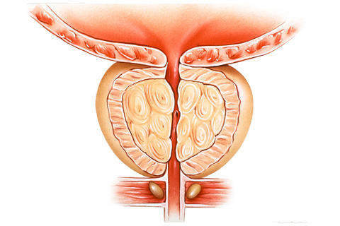 Benign Prostatic Hyperplasia BPH Conditions and Treatments 