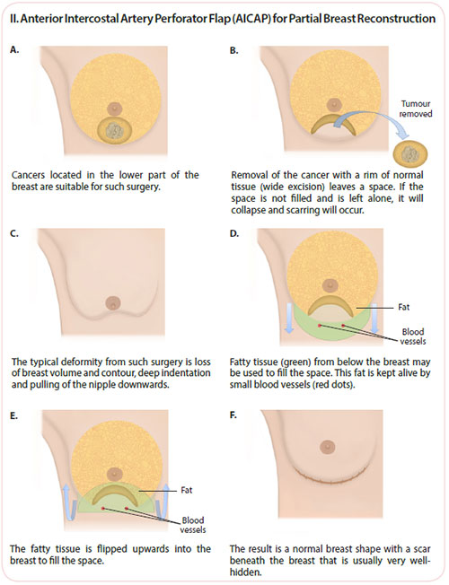 breast cancer treatment - anterior intercostal artery perforator flap (AICAP)