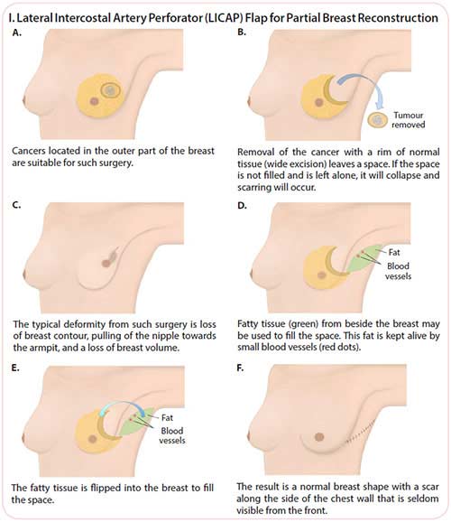 breast cancer treatment - lateral intercostal artery perforator (LICAP)