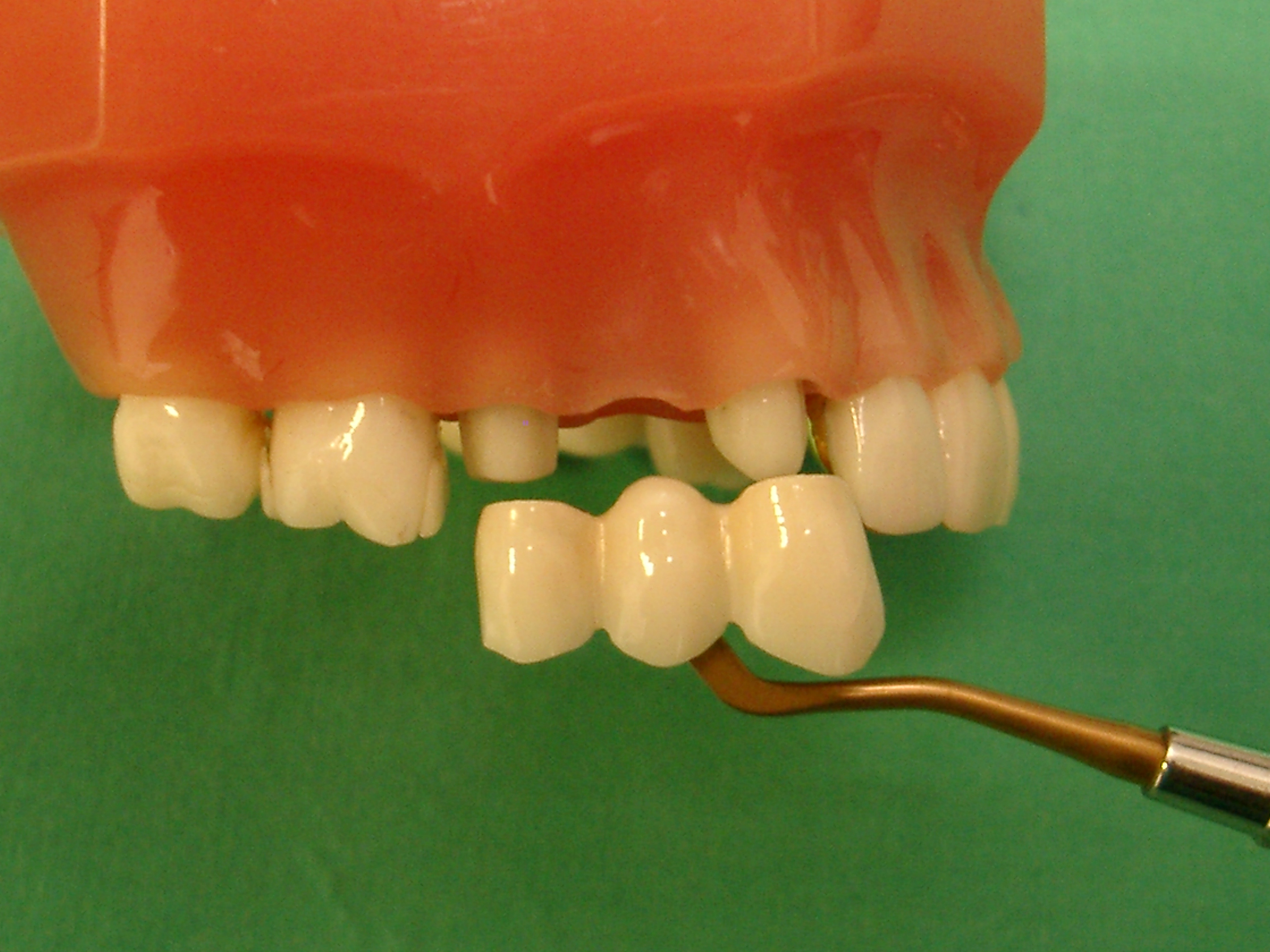 Healthy neighbouring teeth are trimmed to fix the bridge unit onto them, according to the National Dental Centre Singapore