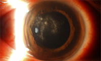 Corneal Infection due to parasite Acanthamoeba - Eye Condition and Treatments SingHealth