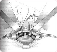 burch colpsuspension conditions & treatments