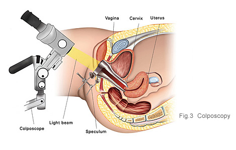 Cervical cancer diagnosis - colposcopy at KKH