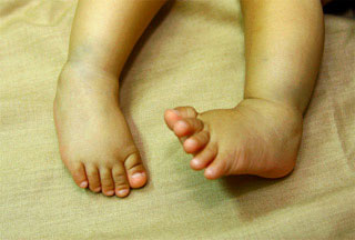 Understanding the Most Common Baby Foot Problems - ePodiatrists