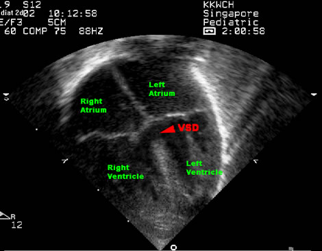 Ventricular septal defect disgnosis at KKH