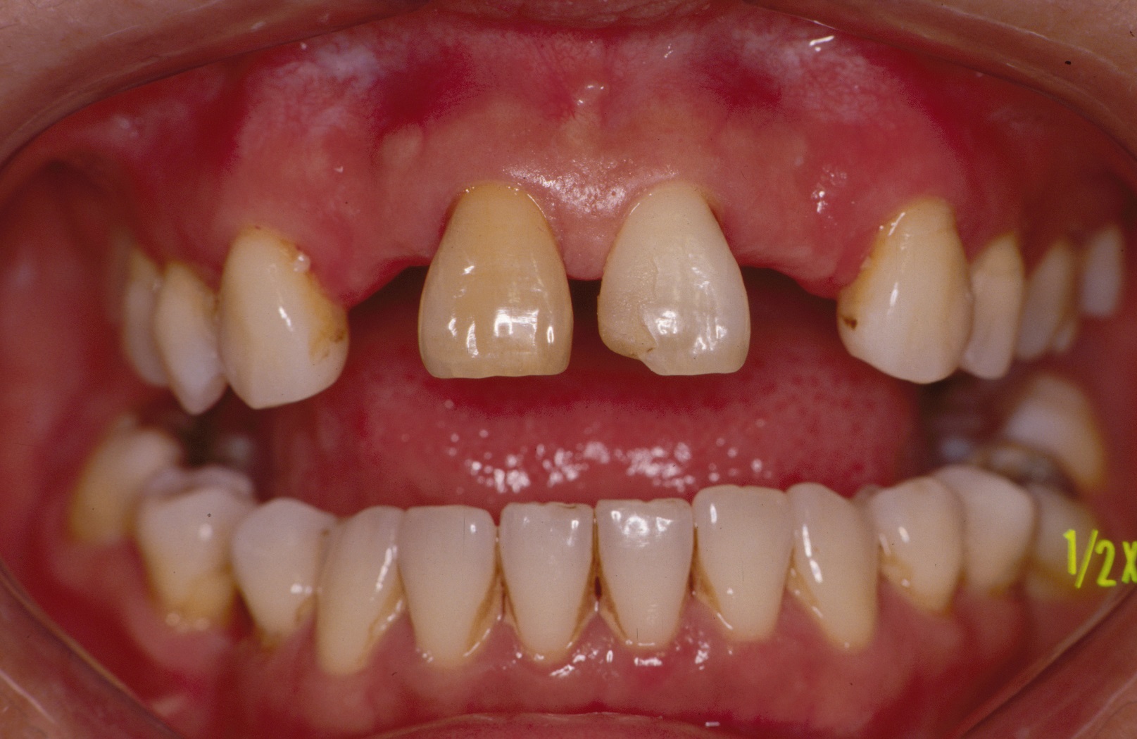 Patient needing resin-bonded bridges, according to the National Dental Centre Singapore