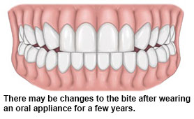 Wearing oral appliance - Obstructive Sleep Apnoea (OSA) Conditions and Treatments