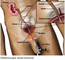 ureteroscopic stone removal as a treatment for kidney stones