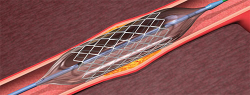 stent heart illustration