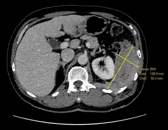 Dedifferentiated liposarcoma - NCCS SPRinT